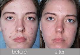 Blue Light Therapy Fights Acne Effectively Aduro Official Brand Owner
