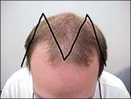 To prevent hair thinning and loss, you might not think to scour the scalp care section, but you'd be wise to, according to dr. Common Hair Loss Disorders American Family Physician