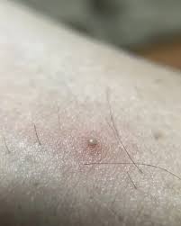 How to get rid of ingrown hair ingrown hair is a problem faced by most women, and women are always looking for a way and they pay dearly to ingrown hairs are hairs that have curled around and grown back into your skin instead of rising up from it. Ingrown Hair Removal How To Get Rid Of Ingrown Hairs Expert Recommends Treatment Express Co Uk