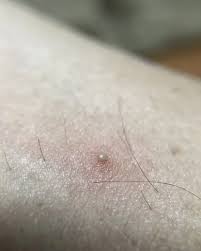 Sometimes people will see a little pustule, so it will look like a pimple, she says. Ingrown Hair Removal How To Get Rid Of Ingrown Hairs Expert Recommends Treatment Express Co Uk