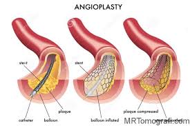 Anjiyo Sonrasi Beslenme Anjiyo Sonrasi Beslenme Recetesi Anjiyo Gen Tr