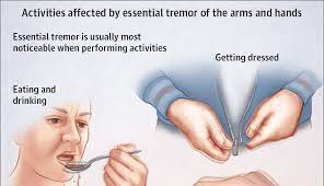 It may come and go, or it may be constant. Health Diagnosing Essential Tremor Movement Disorder Boomers Daily
