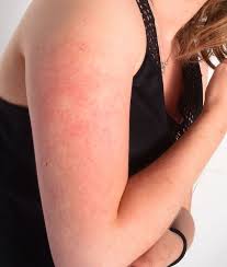 The traditional method of exfoliating was always to use a loofah or body scrub. What Are Those Red Bumps At The Tops Of Your Arms And How Do You Get Rid Of Them Liverpool Echo