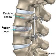 Lumbar Spinal Fusion Surgery Instrumented Anterior Posterior Cage Spinal Fusion Surgery Spinal Fusion Spine Surgery