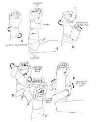 Image result for Short Arm Cast