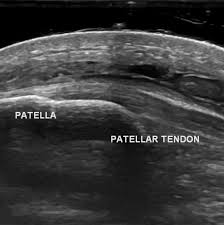 Image result for Prepatellar Bursa Injection