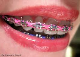 Cute Braces Colors For Teens Girls Cute Braces Colors Cute Braces Braces Colors