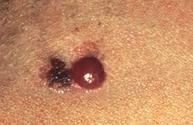 A dermatologist can often perform this type of surgery during an office visit while you remain awake. Foot Melanoma Symptoms Causes And Treatments