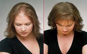 <p>weniger haar heißt nicht weniger stil. Physikalischer Haarersatz Friseur Com