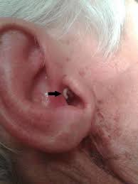 I know i have morgellons aka fly myasis this is working on my 3rd yr. Cureus Aural Myiasis A Case Report On A Rare Entity