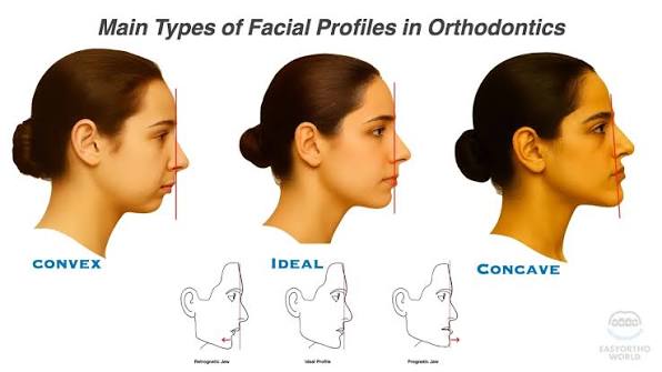 Facial Profile Types In Orthodontics