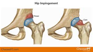The hip muscles encompass many muscles of the hip and thigh whose main function is to act on the thigh at the hip joint and stabilize the pelvis. Physical Therapy Guide To Hip Impingement Femoroacetabular Impingement Choosept Com