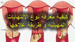 كيفية معرفة نوع الالتهابات المهبلية و طريقة علاجها youtube