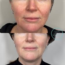 ✨ The Glow-Up Secret: IPL Laser Explained! ✨ Dreaming of smoother, more  radiant skin? IPL (Intense Pulsed Light) therapy might be your new BFF! ⚡  What is IPL? IPL uses light energy