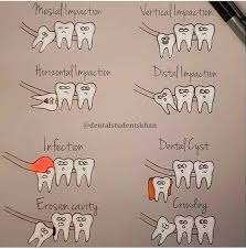 One Of The Many Services We Offer At The Clinic Wisdom Teeth Extractions With Or Without Nitrous Sedatio Dental Hygiene Student Dental Dental Assistant Study