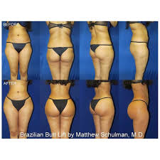 Pin On Brazilian Butt Lift
