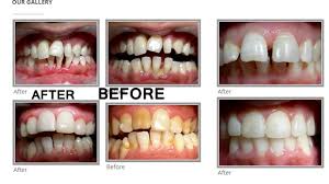 Pin On Best Dentist And Implant Center In Anand Nadiad