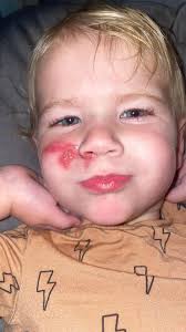 Can I use the boo boo salve