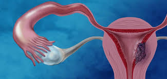 Endometrial cancer, the main form of uterine cancer, is more common in menopausal women. Can Some Women With Endometrial Cancer Forgo Radiation After Surgery Cancer Health