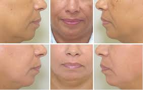 Pain at the injection site. A Review Of Nonsurgical Facial Rejuvenation