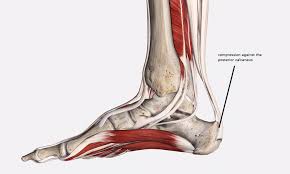 This can be done a true achilles insertional tendon injury can be made worse by shoes with a lower heel height and midfoot. Whitney Lowe Explores Current Views Of Tendon Pathology And Treatment