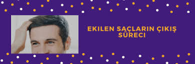 Ekilen Saclar Ne Zaman Cikar Sac Ekim Sac Ekim Fiyat Dhi Sac Ekim