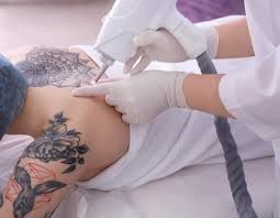 It had been performed experimentally for about twenty years before becoming commercially available in 1995 and 1996. Fort Collins Laser Hair Tattoo Removal Fort Collins Co Laserall