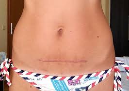 قوي الاستمارة رحلة قصيرة سلك العملية القيصرية dsvdedommel com