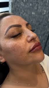 ☑️ LIPS FILLER 👄💉, 📍 Tijuana B.C