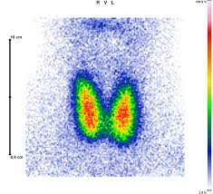 Knoten, die kein technetium speichern, nennt man auch „kalte knoten. Nuklearmedizin Radiologische Praxis Bitburg