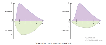 Image result for Vocal Cord Dysfunction