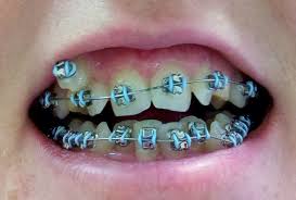 I Love The Color Of The Bands Braces Colors Teeth Braces Dental Braces