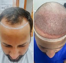 Com seus 44 anos de idade, já era esperado que as famosas 'entradinhas' começassem a aparecer. Walef Marques Realiza Implante Capilar E Surpreende Seus Seguidores Cartao De Visita News