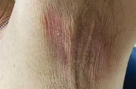 Image result for Erythrasma