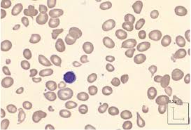 Image result for Anemia angolensis