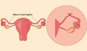 Chances Of Getting Pregnant After Tubal Ligation During C Section Best Doctors Surgery Tourism India