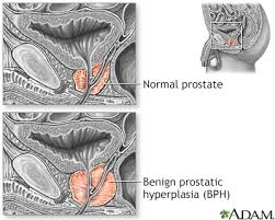 In rare cases, you may be diagnosed with a new cancer that's completely unrelated to your first cancer. Enlarged Prostate Information Mount Sinai New York