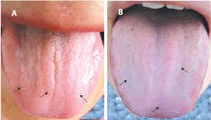 purple bluish tongue is associated with platelet counts and