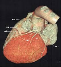 Introduction anatomically coronary arteries are not end arteries. Myocardial Bridges A Forgotten Condition A Review