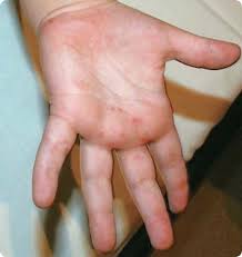 Image result for Hand foot and mouth disease HFMD roof of mouth
