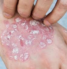 Keratosis pilaris has a genetic aspect according to medline plus and tends to occur more commonly in people with very dry skin. Psoriasis And Keratosis Pilaris What To Know