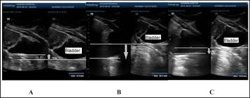 If your doctor orders a pelvic ultrasound exam, images can be captured in two different ways: Transabdominal Ultrasound Imaging Of Pelvic Floor Muscle Activity In Women With And Without Stress Urinary Incontinence A Case Control Study Journal Of Obstetrics And Gynaecology Canada