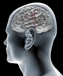 When the aneurysm ruptures, it causes bleeding into the brain or hemorrhagic stroke. What Is A Brain Aneurysm Symptoms And Causes Explained