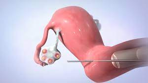 In Vitro Fertilization Ivf Youtube