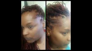 Protein is the building blocks that our bodies use to heal itself and grow, including hair. Weight Loss Surgery Gastric Bypass Hair Loss After Surgery Locs Dreads Youtube