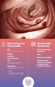 Image result for Diverticulitis
