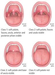 Image result for Obstructive Sleep Apnea
