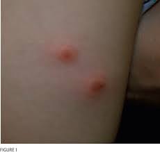 Image result for Papular urticaria