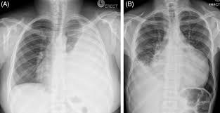 Pleural eﬀusions can loculate as a result of adhesions. Loculated Pleural Effusion Chest X Ray Pleural Effusions In The Pediatric Population American Academy Of Pediatrics Related Online Courses On Physioplus Catrinak Milky