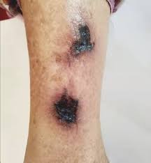 Image result for Calciphylaxis